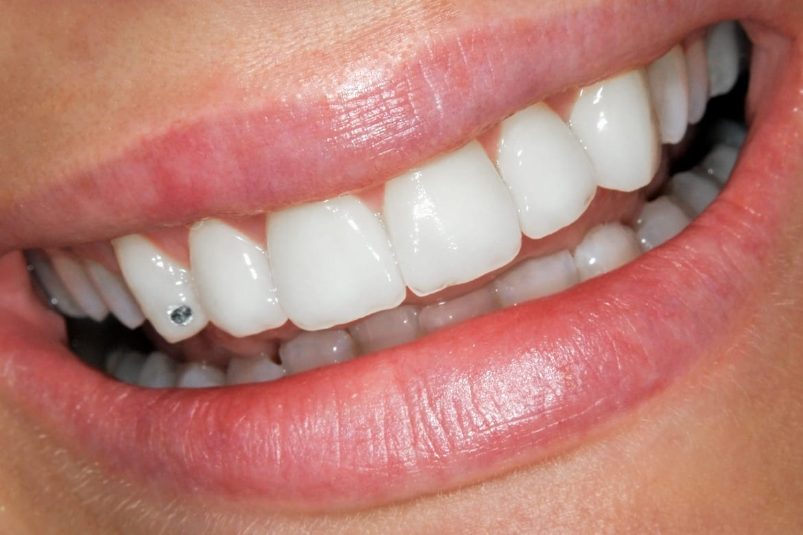 Tannsmykke_herobilde_behandling Tannsmykke på en tann