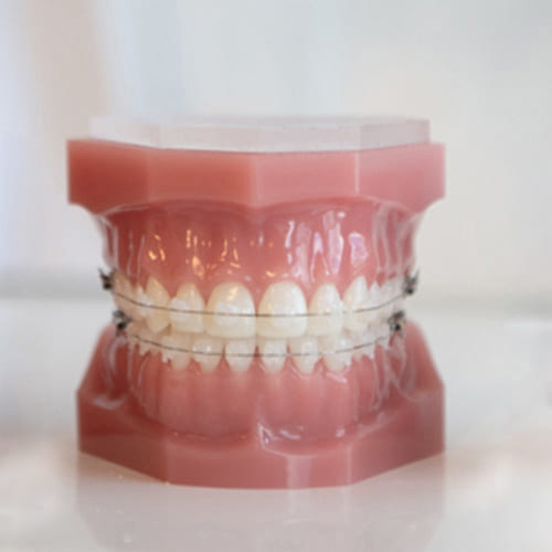 Keramisk tannregulering