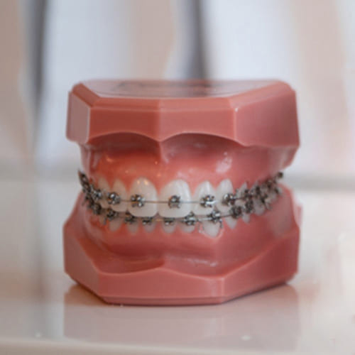 Modell tradisjonell-tannregulering